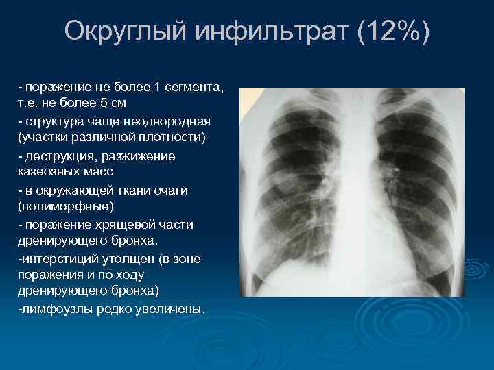 Округлый инфильтрат (12%) - поражение не более 1 сегмента, т. е. не более 5