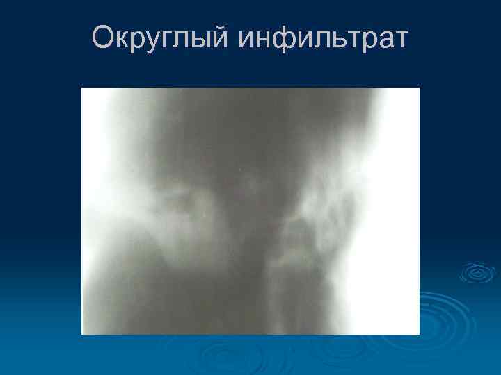 Округлый инфильтрат 