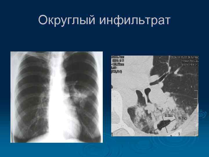 Округлый инфильтрат 