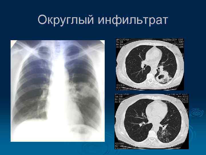 Округлый инфильтрат 