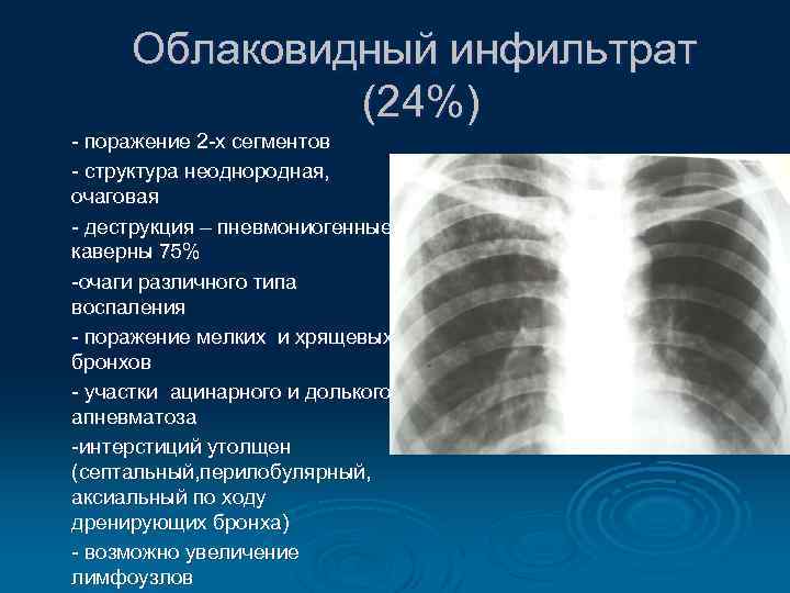 Облаковидный инфильтрат (24%) - поражение 2 -х сегментов - структура неоднородная, очаговая - деструкция