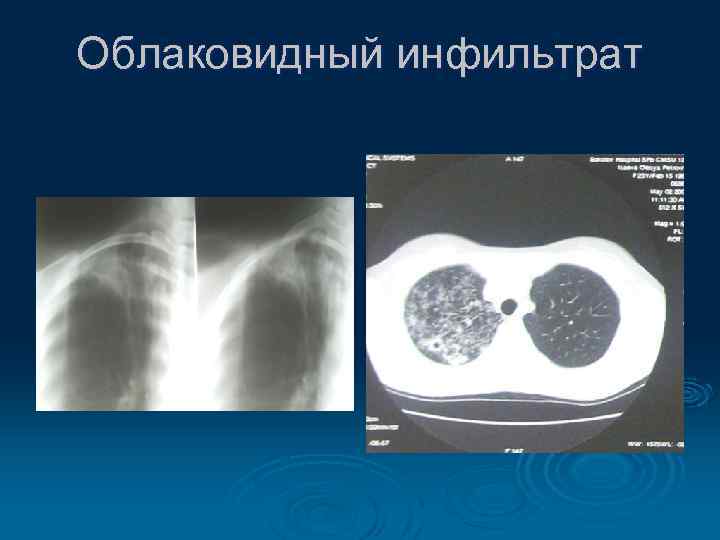 Облаковидный инфильтрат 
