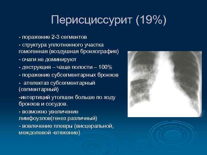 Перисциссурит (19%) - поражение 2 -3 сегментов - структура уплотненного участка гомогенная (воздушная бронхография)