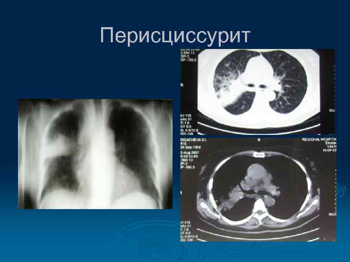 Перисциссурит 