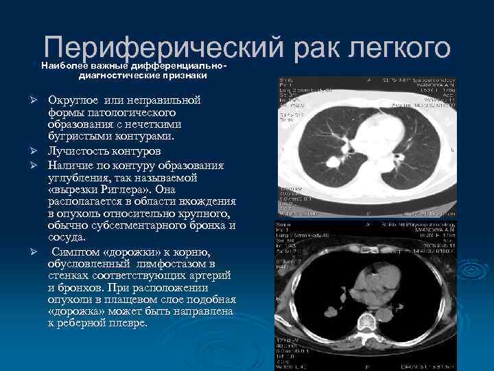 Периферический рак легкого Наиболее важные дифференциальнодиагностические признаки Ø Ø Округлое или неправильной формы патологического