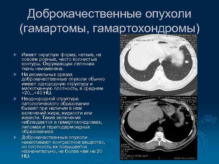 Доброкачественные опухоли (гамартомы, гамартохондромы) Имеют округлую форму, четкие, не совсем ровные, часто волнистые контуры.