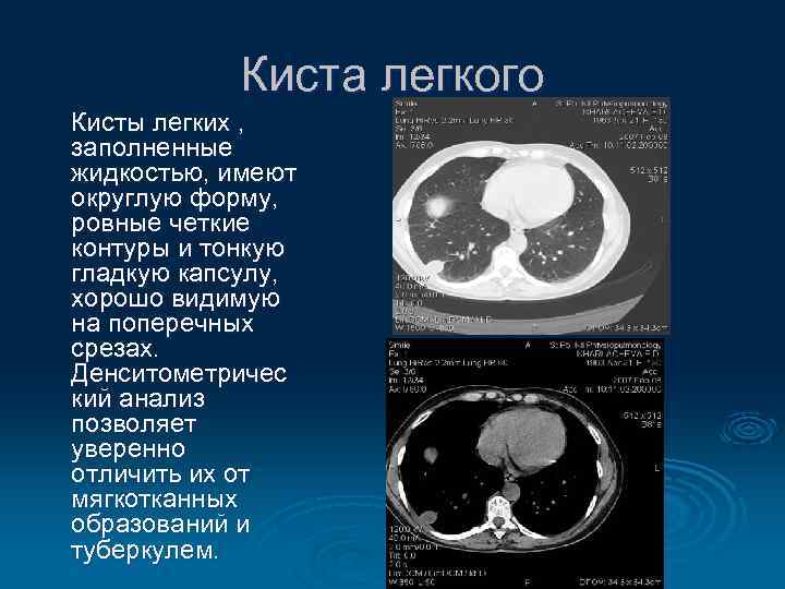 Киста легкого Кисты легких , заполненные жидкостью, имеют округлую форму, ровные четкие контуры и