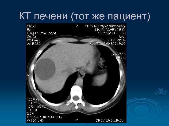 КТ печени (тот же пациент) 