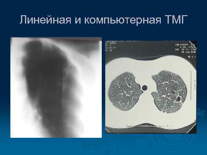 Линейная и компьютерная ТМГ 