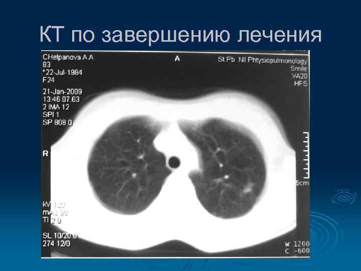 КТ по завершению лечения 