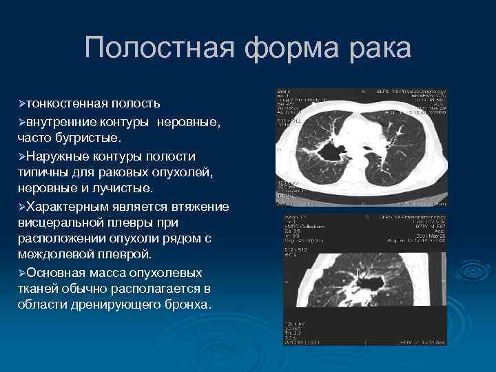 Полостная форма рака Øтонкостенная полость Øвнутренние контуры неровные, часто бугристые. ØНаружные контуры полости типичны