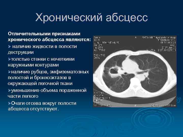 Хронический абсцесс Отличительными признаками хронического абсцесса являются: Ø наличие жидкости в полости деструкции Øтолстые