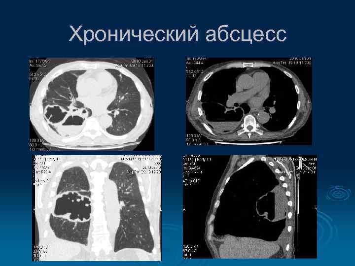Хронический абсцесс 