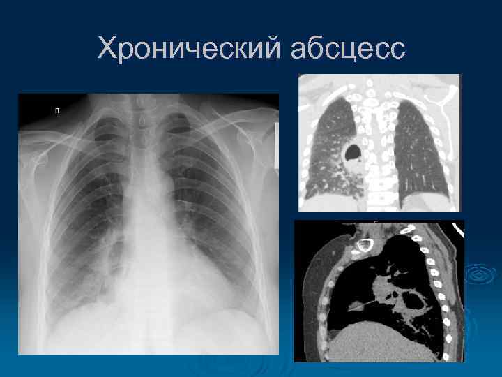 Хронический абсцесс 