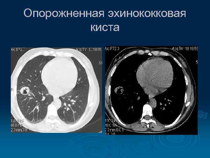 Опорожненная эхинококковая киста 