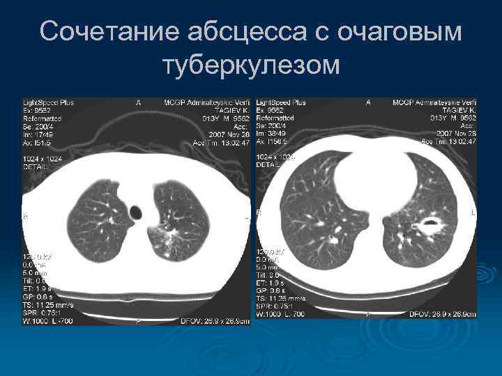 Сочетание абсцесса с очаговым туберкулезом 