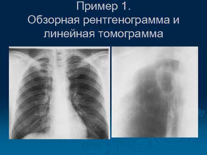 Пример 1. Обзорная рентгенограмма и линейная томограмма 