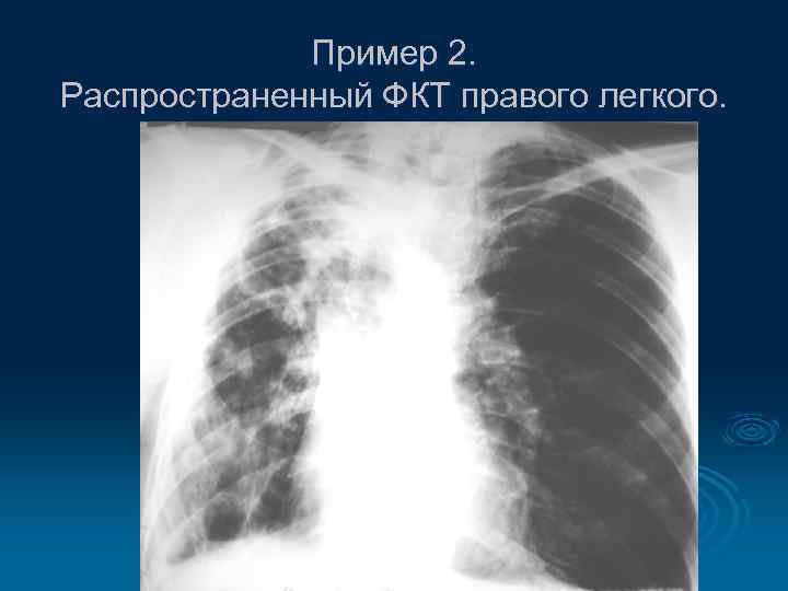 Пример 2. Распространенный ФКТ правого легкого. 