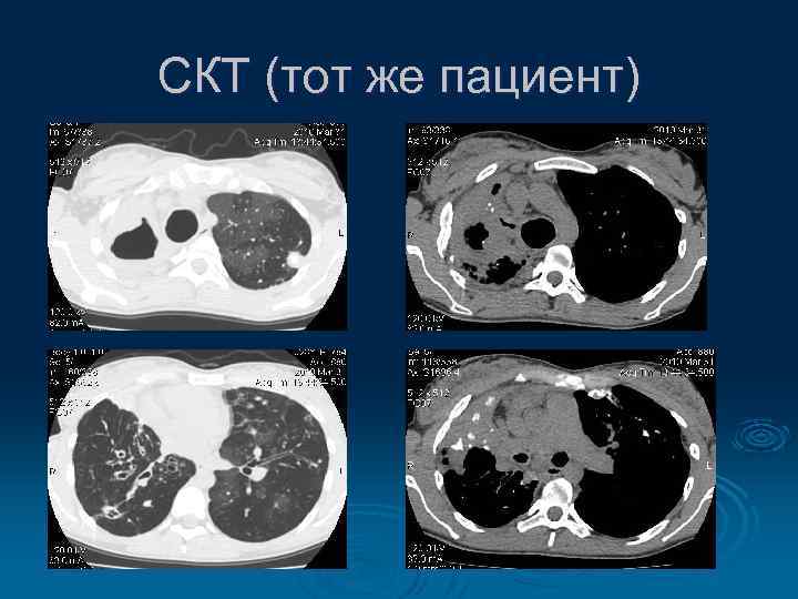 СКТ (тот же пациент) 