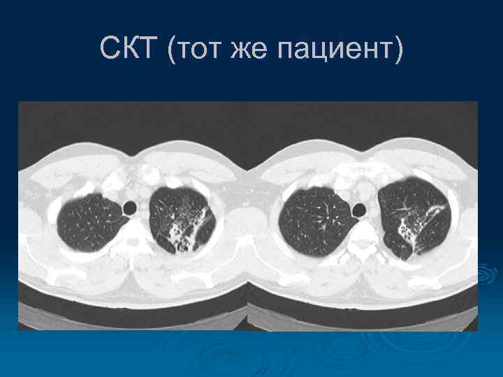 СКТ (тот же пациент) 