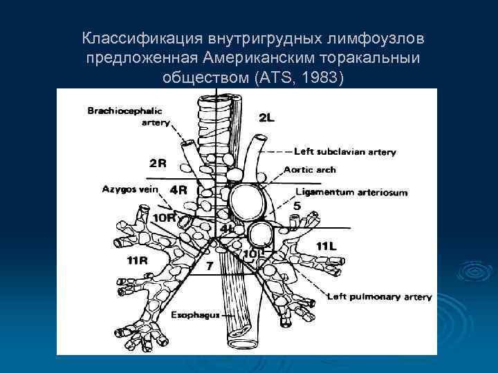 Классификация внутригрудных лимфоузлов предложенная Американским торакальныи обществом (ATS, 1983) 