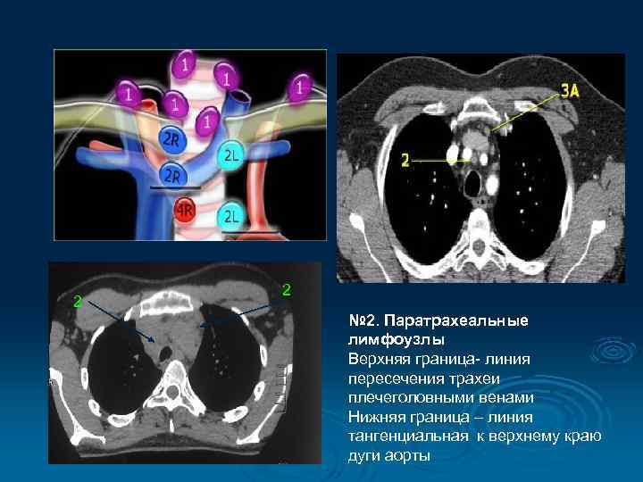 2 2 № 2. Паратрахеальные лимфоузлы Верхняя граница- линия пересечения трахеи плечеголовными венами Нижняя