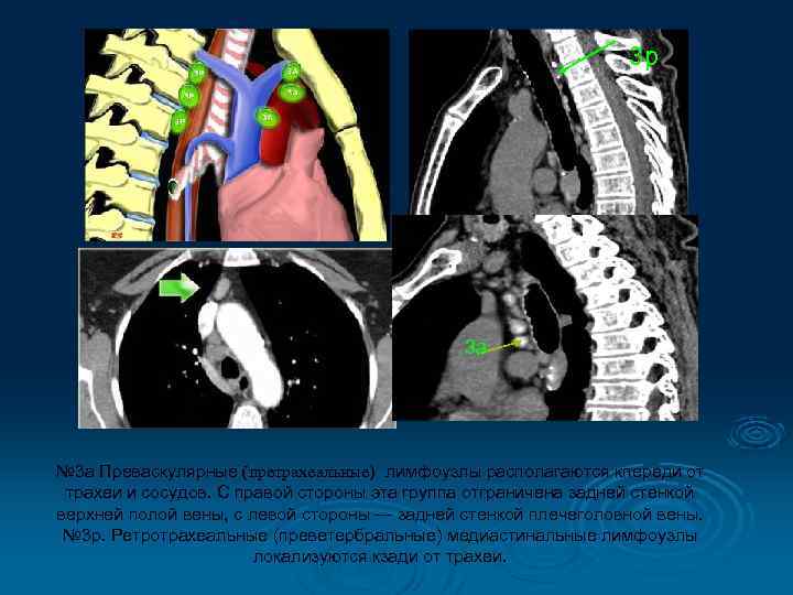 3 p 3 a № 3 а Преваскулярные (претрахеальные) лимфоузлы располагаются кпереди от трахеи