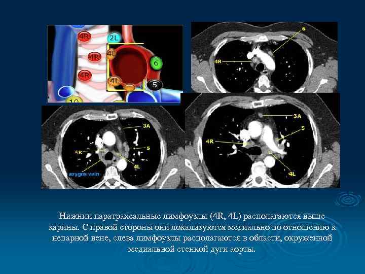 Нижнии паратрахеальные лимфоузлы (4 R, 4 L) располагаются выше карины. С правой стороны они