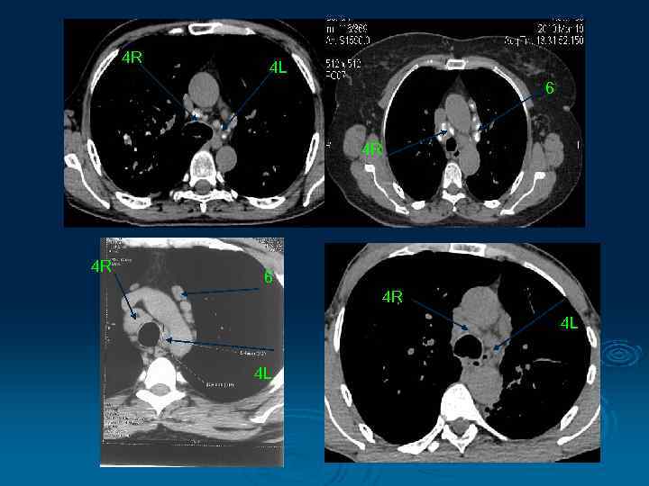 4 R 4 L 6 4 R 4 R 6 4 R 4 L