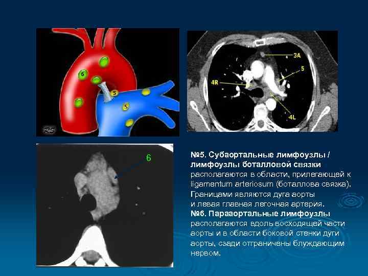 6 № 5. Субаортальные лимфоузлы / лимфоузлы боталловой связки располагаются в области, прилегающей к