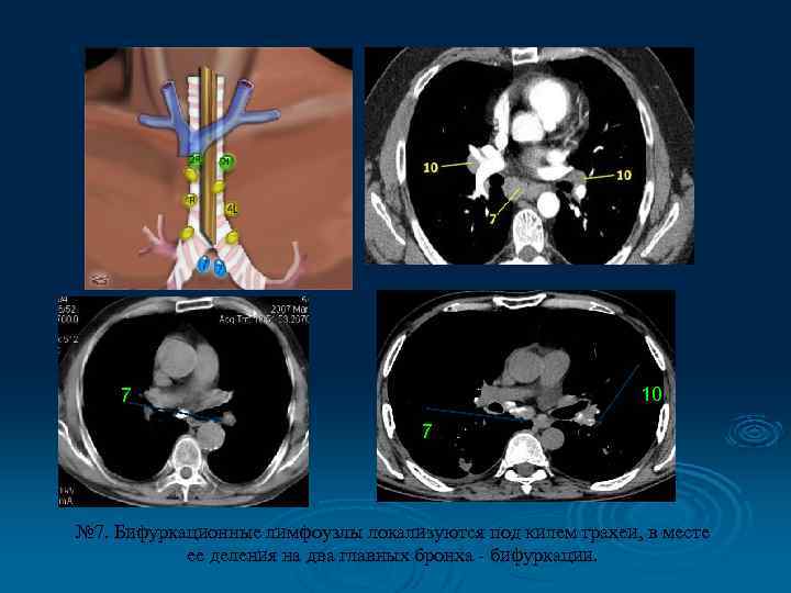 10 7 7 № 7. Бифуркационные лимфоузлы локализуются под килем трахеи, в месте ее