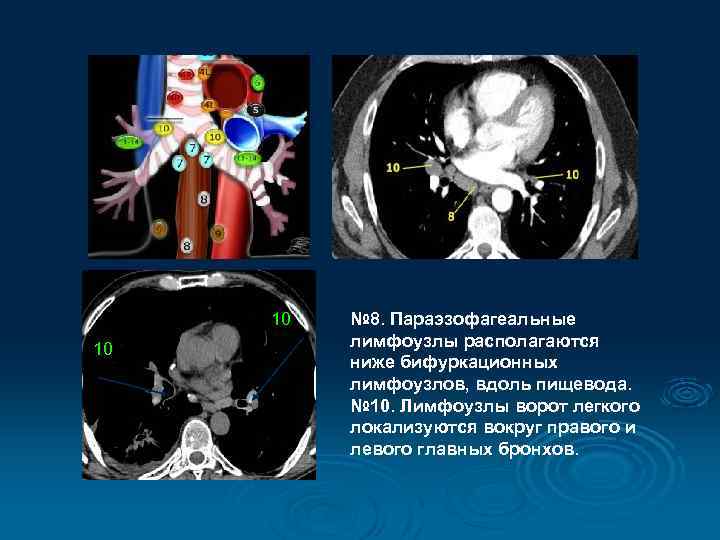 10 10 № 8. Параэзофагеальные лимфоузлы располагаются ниже бифуркационных лимфоузлов, вдоль пищевода. № 10.