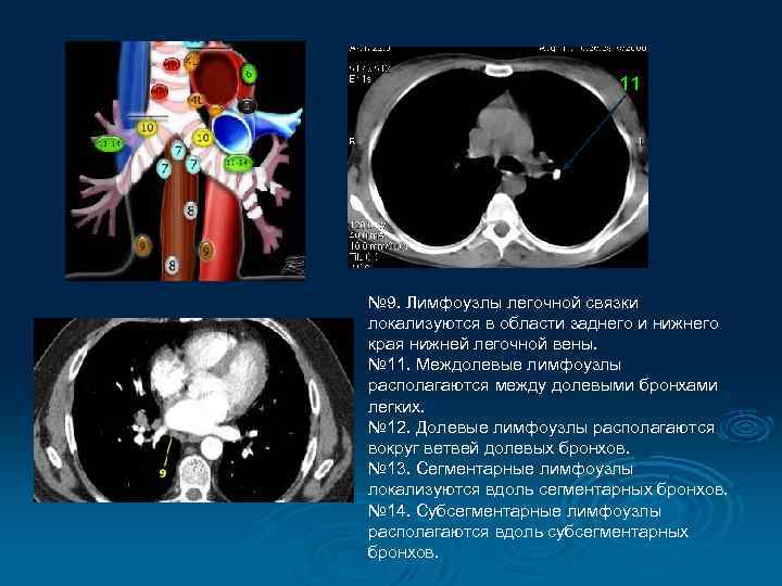 11 № 9. Лимфоузлы легочной связки локализуются в области заднего и нижнего края нижней