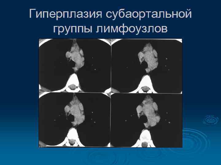 Гиперплазия субаортальной группы лимфоузлов 