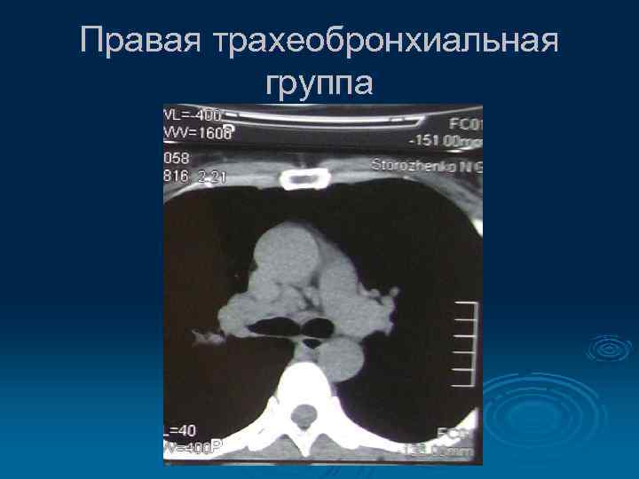 Правая трахеобронхиальная группа 