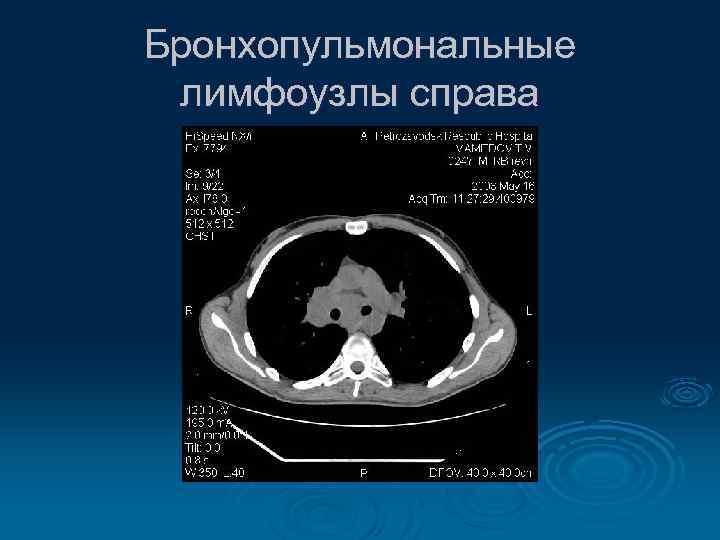 Бронхопульмональные лимфоузлы справа 