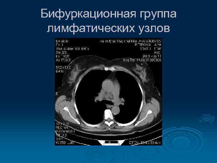 Бифуркационная группа лимфатических узлов 