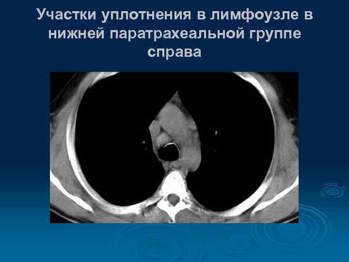 Участки уплотнения в лимфоузле в нижней паратрахеальной группе справа 