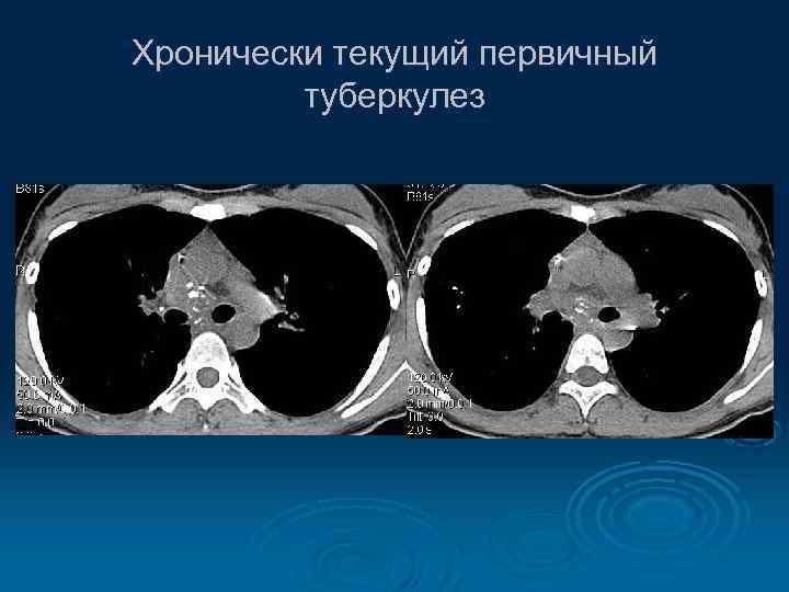 Хронически текущий первичный туберкулез 