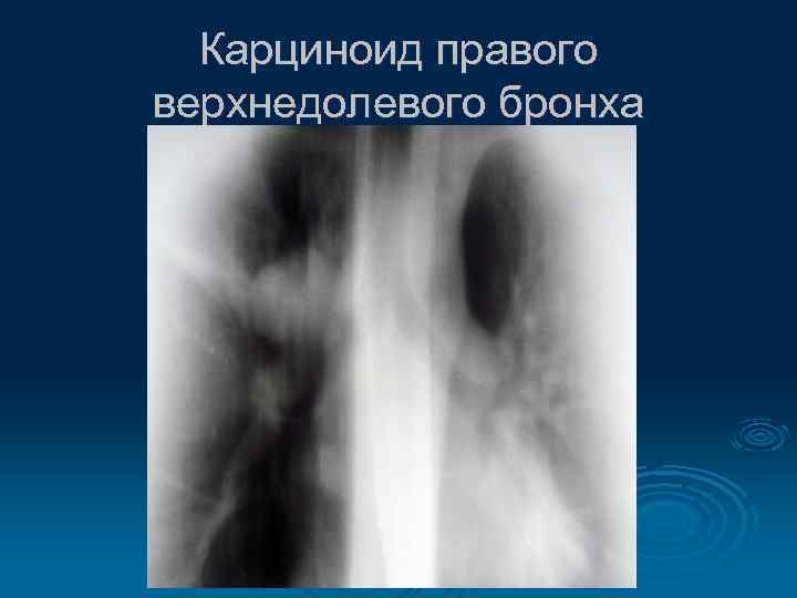 Карциноид правого верхнедолевого бронха 