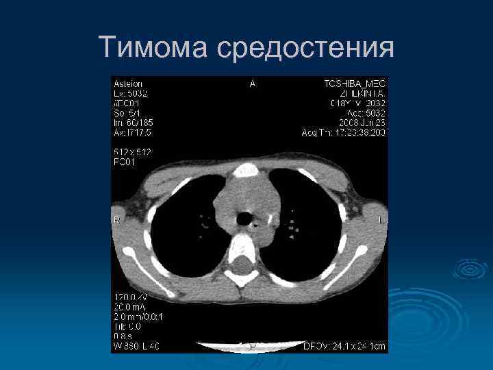 Тимома средостения 
