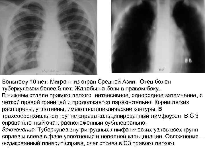 Больному 10 лет. Мигрант из стран Средней Азии. Отец болен туберкулезом более 5 лет.