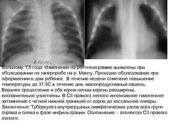 Больному 1, 5 года. Изменения на рентгенограмме выявлены при обследовании по гиперпробе на р.