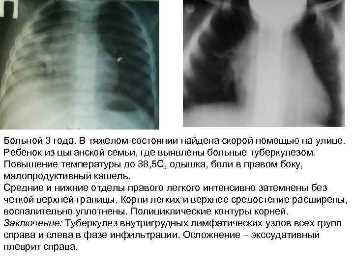 Больной 3 года. В тяжелом состоянии найдена скорой помощью на улице. Ребенок из цыганской