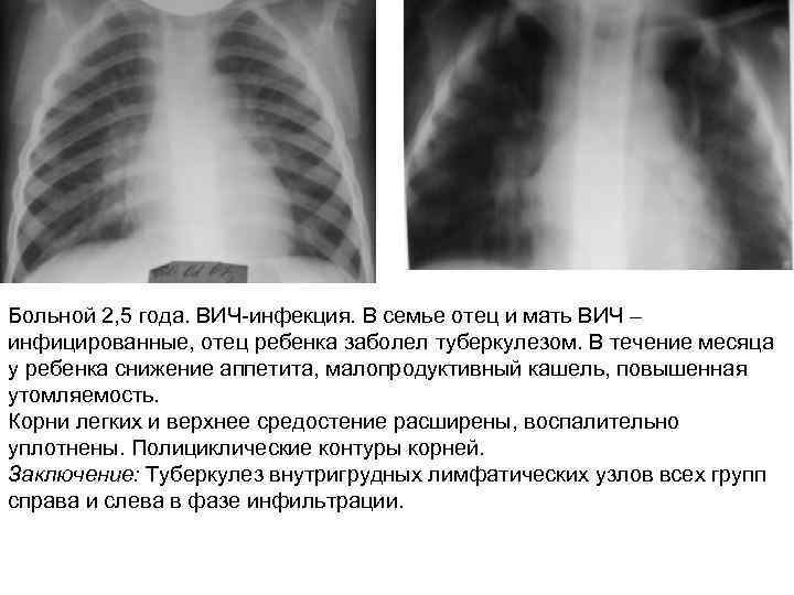 Больной 2, 5 года. ВИЧ-инфекция. В семье отец и мать ВИЧ – инфицированные, отец