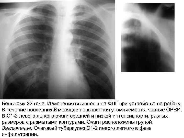 Больному 22 года. Изменения выявлены на ФЛГ при устройстве на работу. В течение последних