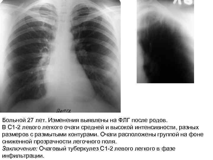 Больной 27 лет. Изменения выявлены на ФЛГ после родов. В С 1 -2 левого