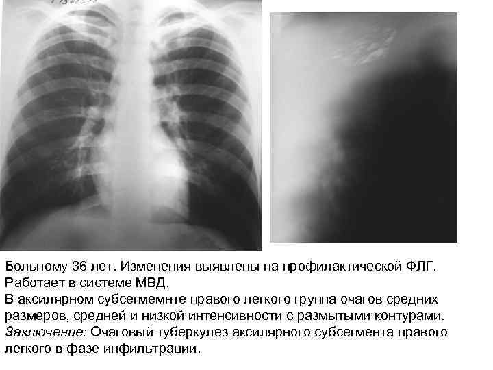 Больному 36 лет. Изменения выявлены на профилактической ФЛГ. Работает в системе МВД. В аксилярном