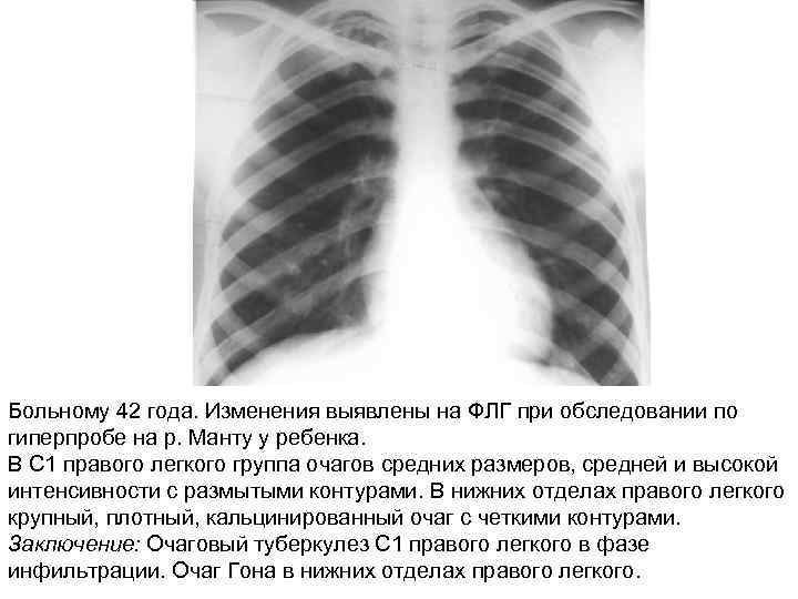 Больному 42 года. Изменения выявлены на ФЛГ при обследовании по гиперпробе на р. Манту