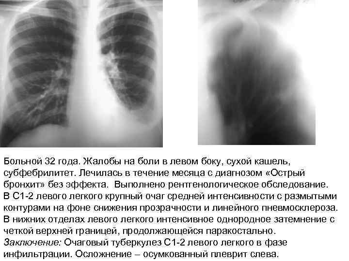 Больной 32 года. Жалобы на боли в левом боку, сухой кашель, субфебрилитет. Лечилась в